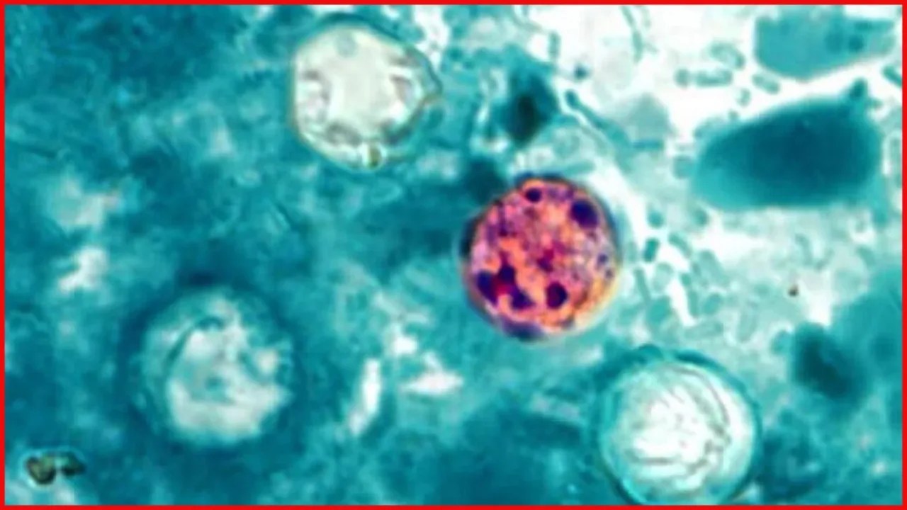 US parasite outbreak